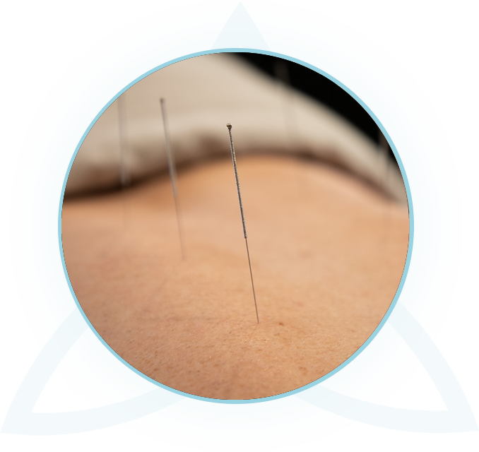 Acupuncture needles